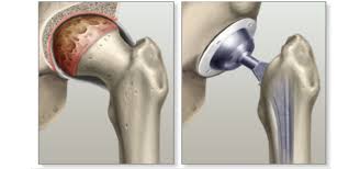 TOTAL HIP REPLACEMENT image